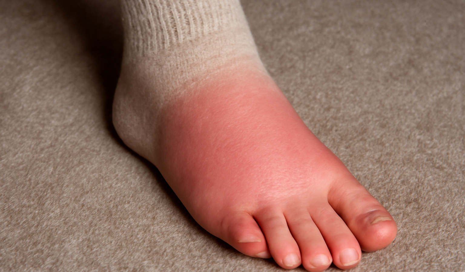pied rouge légèrement enflé dans une chaussette