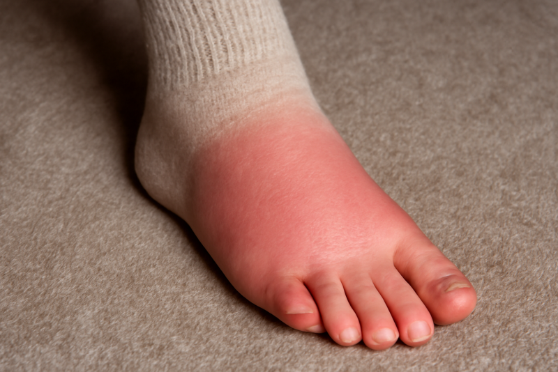 pied rouge légèrement enflé dans une chaussette